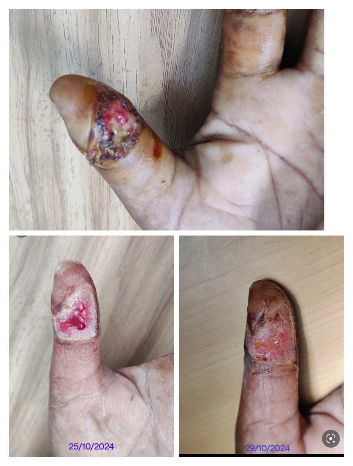 বার্ন ও ট্রমা চিকিৎসা: আগুনে পোড়া এবং দুর্ঘটনা-জনিত আঘাতের সঠিক পরিচর্যা